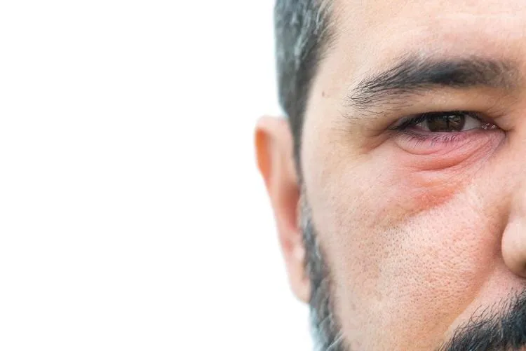 Ways to Get Rid of a Cyst on the Eyelid